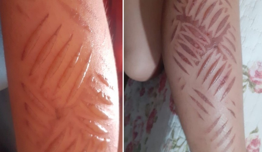 Voltando de Santa Tereza, menina de oito anos encosta perna em assoalho de ônibus e sofre grave queimadura