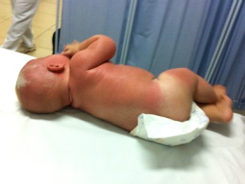 Bebê que teve queimaduras após exposição ao sol deixa o hospital